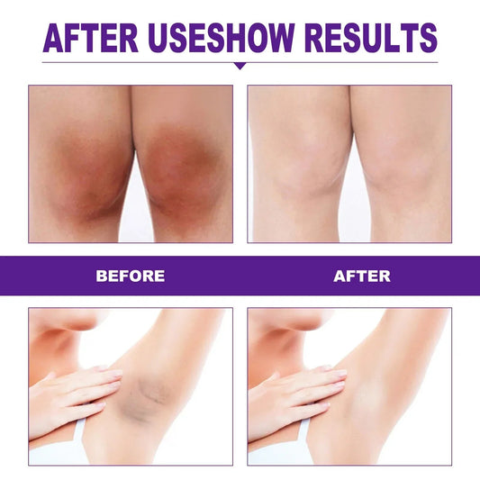 Whitening Cream for Underarm, Butt, Knee Inner Thigh & Intimate Parts